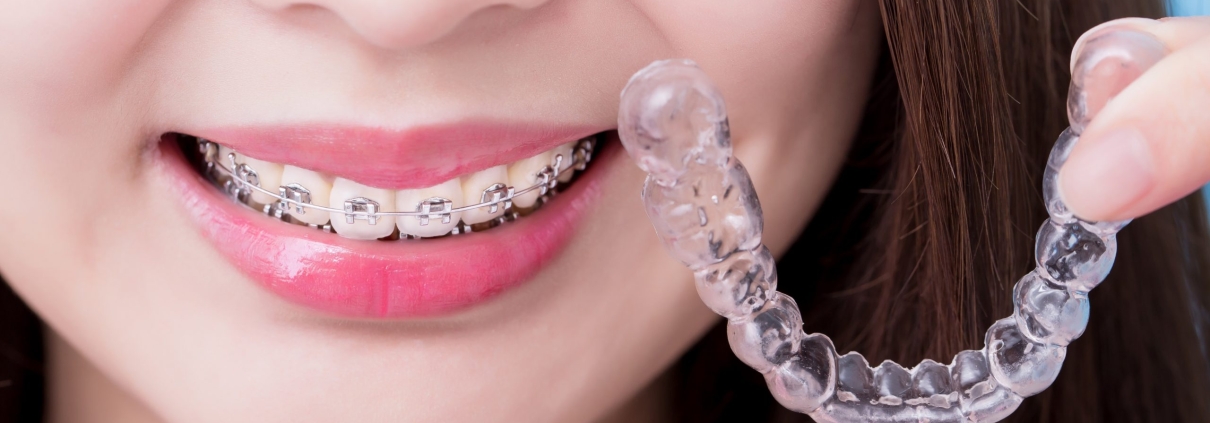 Invisalign® FAQs