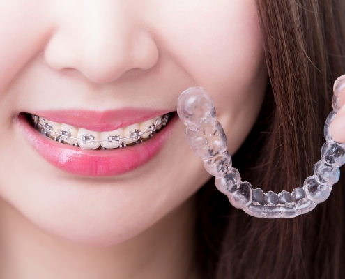 Invisalign® FAQs